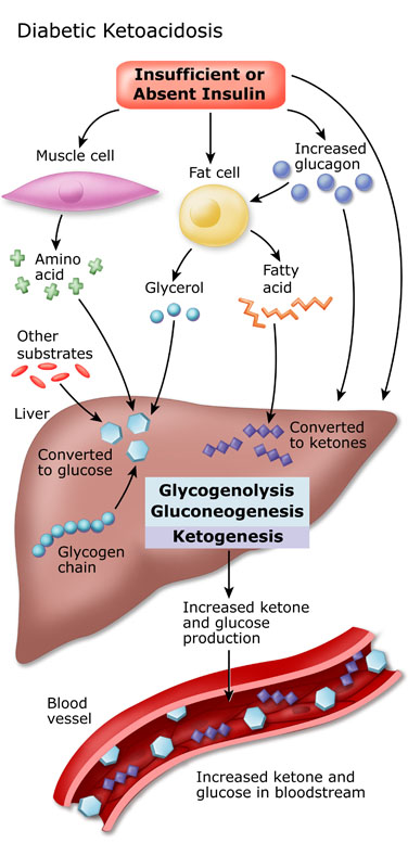 Diagram shows an illustration of a liver and how sugars dealt with in patients with type 1 diabetes.